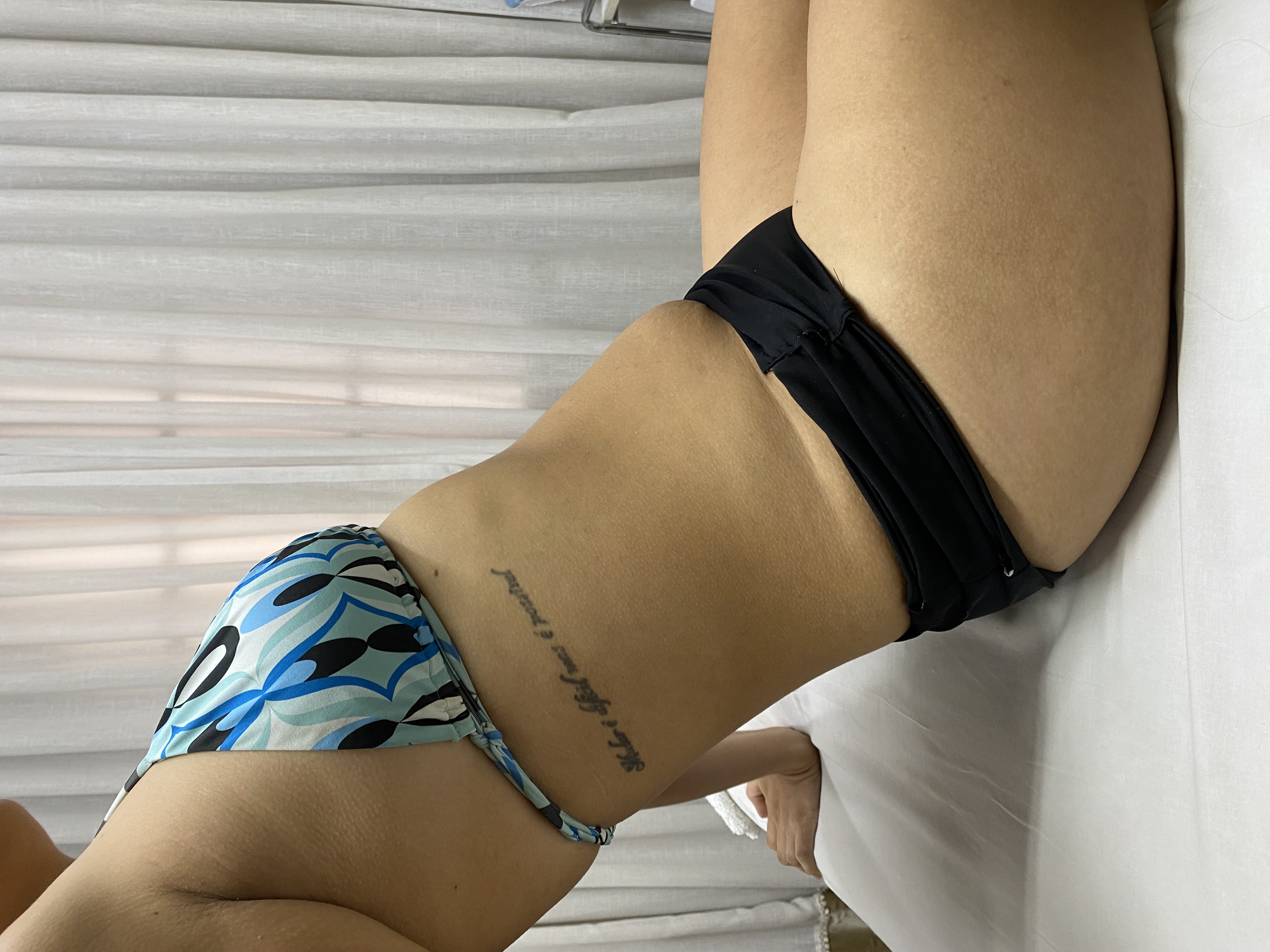 Paciente 1, depois, lado